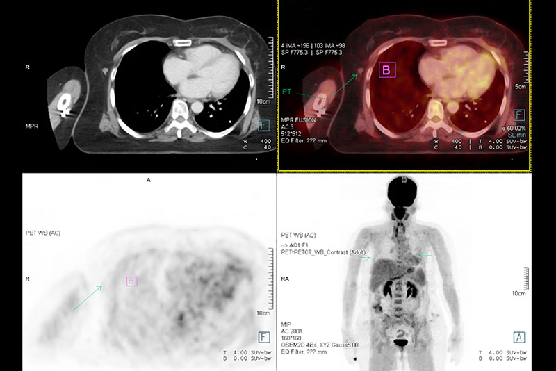 PET CT Scan image of whole body comparison Axial plane in CT scan and PET CT for detect cancer recurrence in patient lung cancer disease.