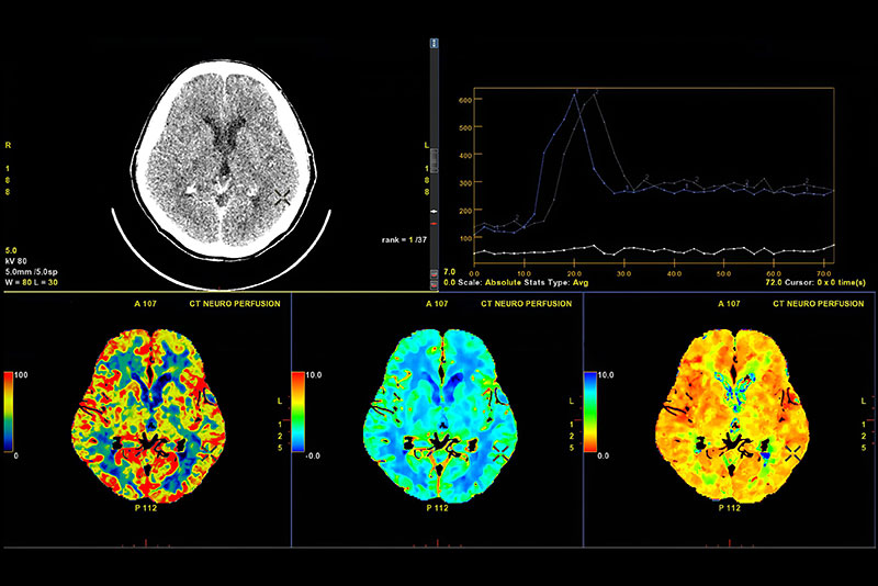 CT Brain Perfusion or CT scan image of the brain 3d rendering image analysing cerebral blood flow on the monitor.