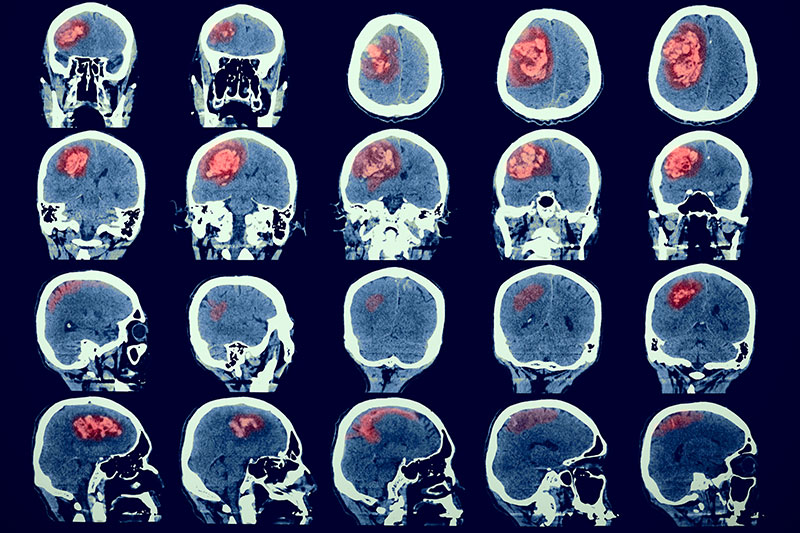 Image of the human brain with the pathology